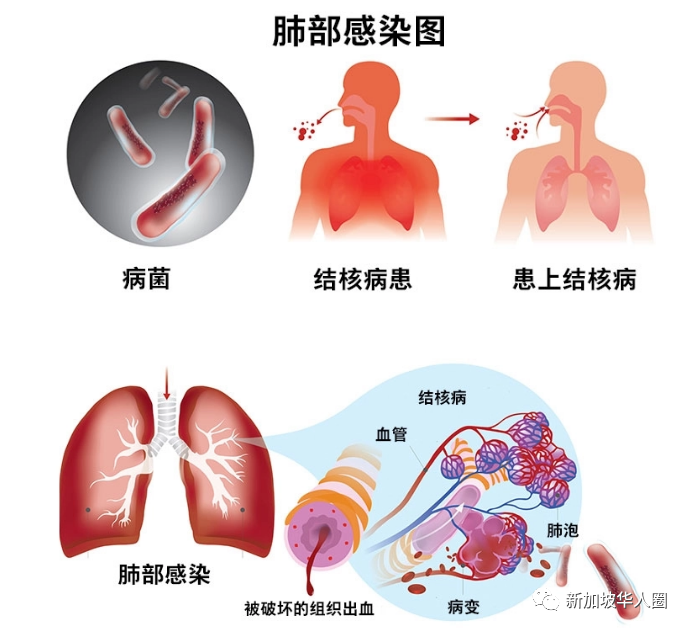 肺病感染最新研究进展与高效治疗策略探讨